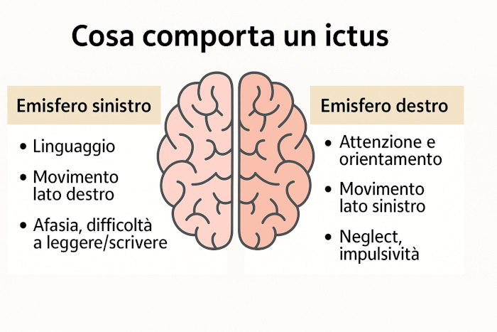 Cosa succede dopo un ictus